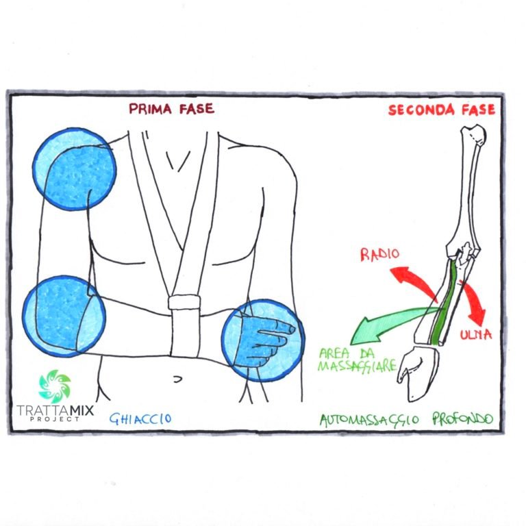 Frattura polso riabilitazione a casa