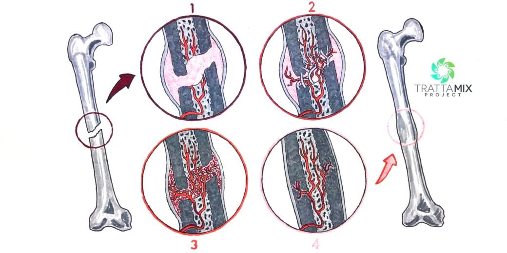 in quanto tempo si calcifica una frattura