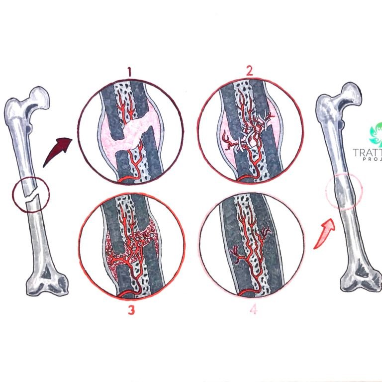 in quanto tempo si calcifica una frattura