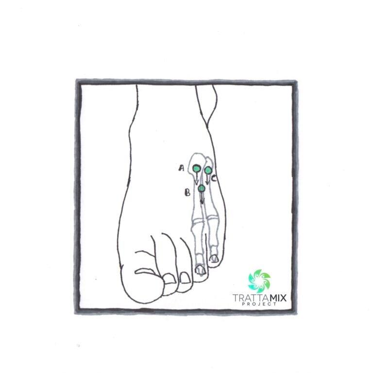 frattura mignolo piede camminare