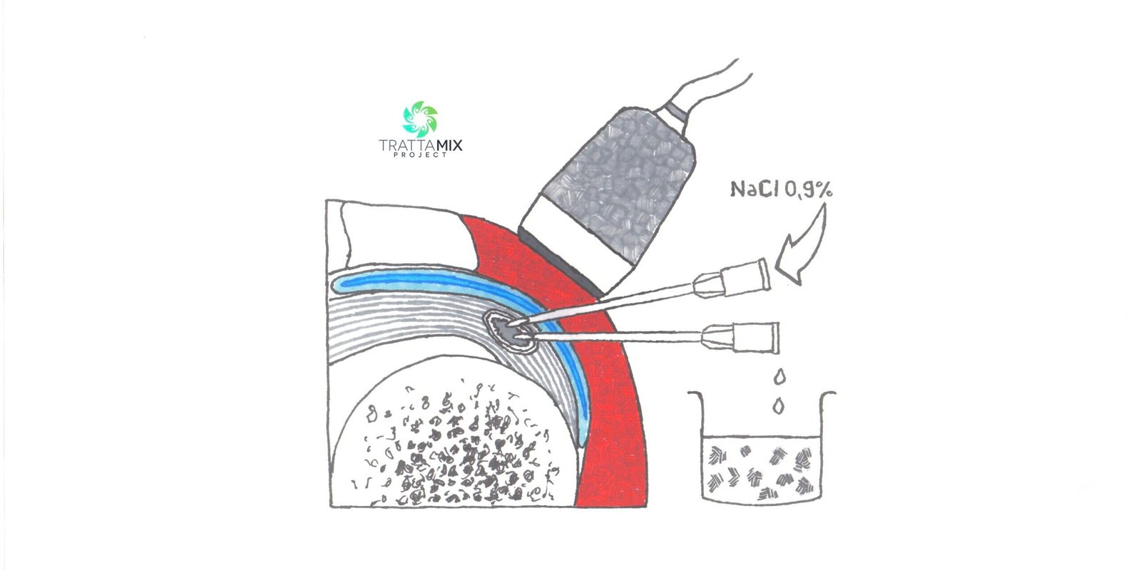 Lavaggio calcificazione spalla tempi di recupero