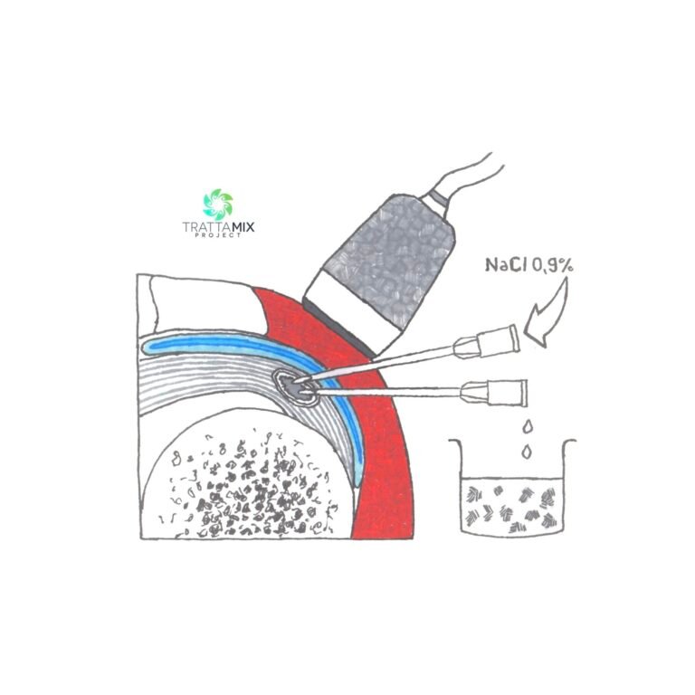 Lavaggio calcificazione spalla tempi di recupero