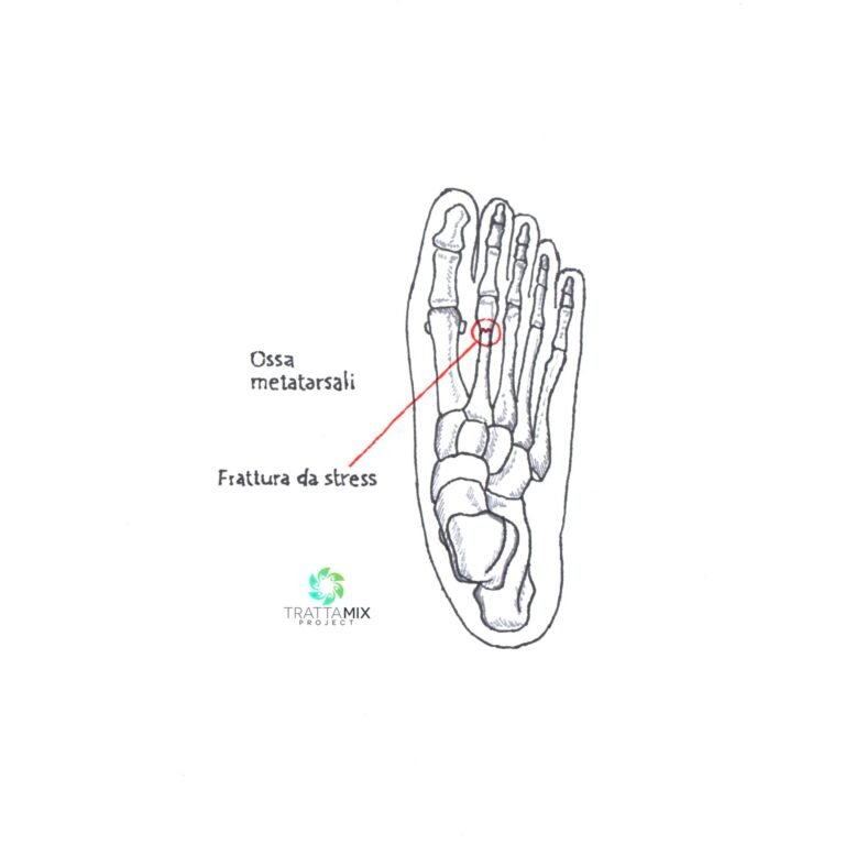 Frattura da stress piede