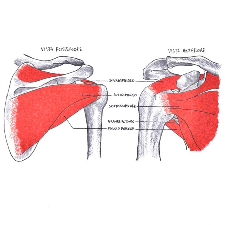 Periartrite scapolo-omerale