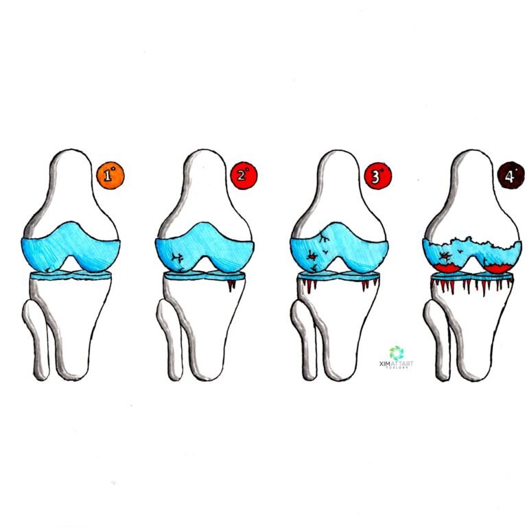 condropatia femoro-rotulea