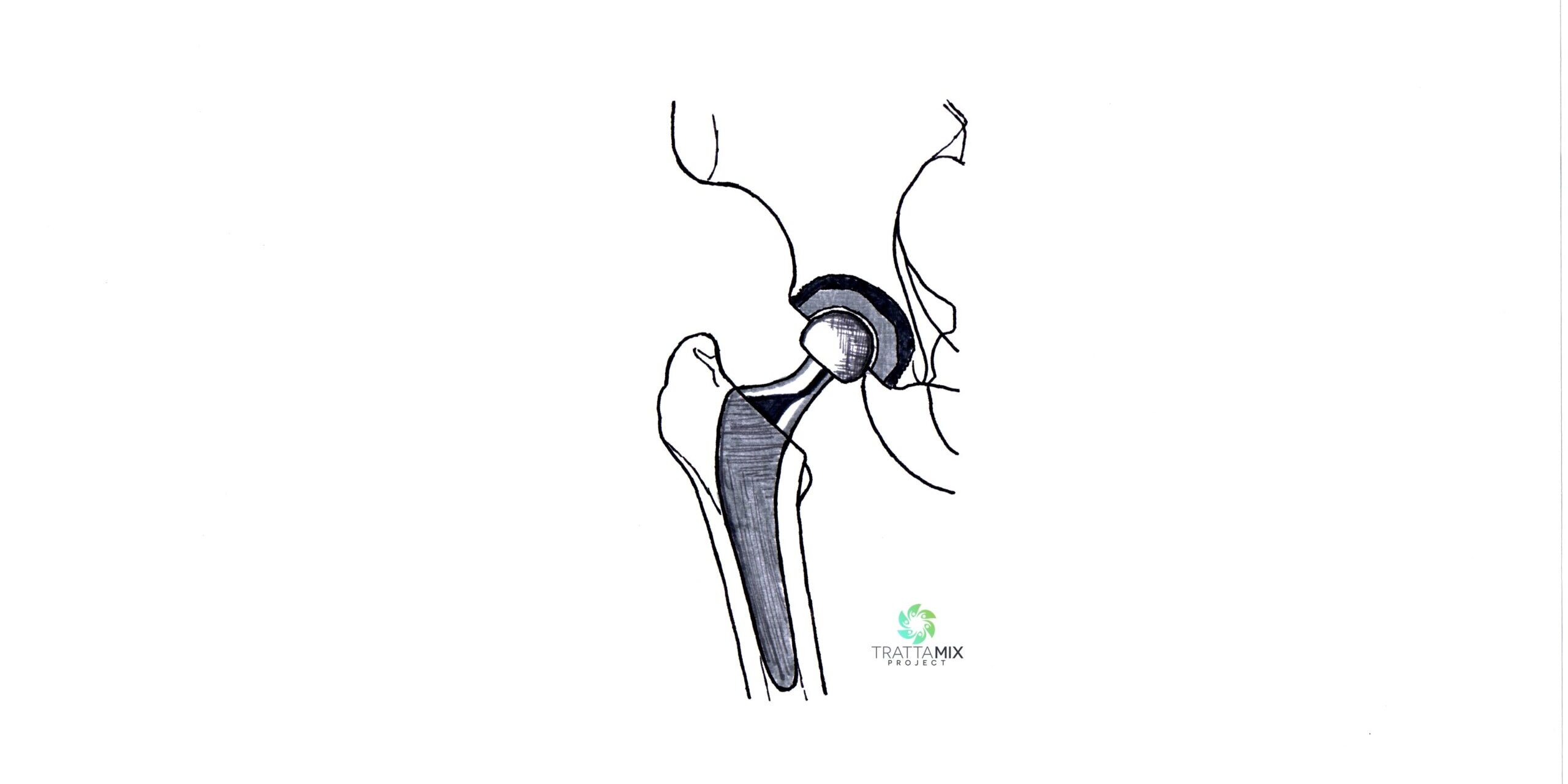 Dolori muscolari dopo protesi anca – CAUSE e SOLUZIONI – Trattamix